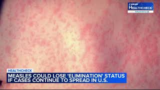 Measles outbreak puts elimination status at risk CDC [upl. by Fairley]