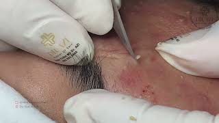 Satisfying Relaxing with Vien Tham My DrAZI vienthammydrazi0052 acne pimples [upl. by Oswin85]