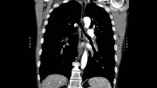 Acute massive pulmonary embolism with right heart strain CT Coronal JETem 2017 [upl. by Frida]