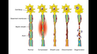 Degrees 1 2 3 4 5 of Nerve injury  Axonotmesis and Neurotmesis [upl. by Bernardine]