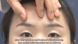 Endoscopic foreheadeyebrow lift of young people Eng dubbed with subtitles [upl. by Naelopan482]