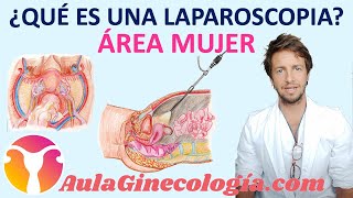 QUÉ ES UNA LAPAROSCOPIA PARA QUÉ SIRVE Y QUÉ VENTAJAS TIENE  Ginecología y Obstetricia [upl. by Akimot]