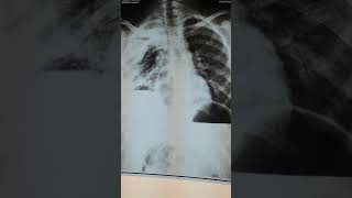 Is it hydropneumothorax really [upl. by Annyl]