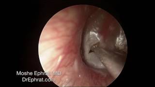 ENDOCSOPIC MUCOID OTITIS MEDIA DRAINAGE [upl. by Alvinia]