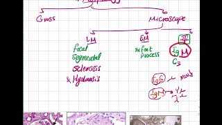 Focal Segmental amp Membranoproliferative GN [upl. by Llennahc709]