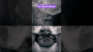 Os Odontoideum shorts radiology xray anatomy [upl. by Lipkin694]