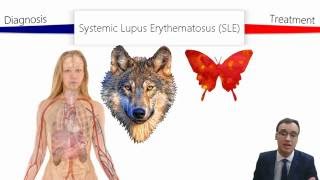 Systemic Lupus Erythematosus SLE [upl. by Marcellina]