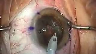 Modern Cataract Surgery Alcon ReSTOR IOL with LRI [upl. by Drarig375]