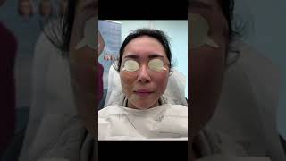 Miracu PDO thread Face Lift Treatment by Dr Tsay  Ageless MD [upl. by Kyle]