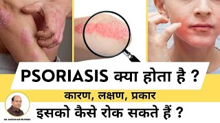 Psoriasis in Hindi Symptoms Causes Types Treatment  सोरायसिस क्या है कारण लक्षण प्रकार [upl. by Canale]