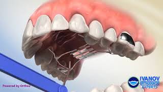 Palatal Expander Appliance and How It Helps [upl. by Ledif459]