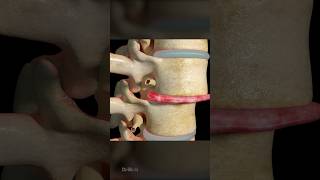 Intervertebral Disc Replacement 3D Animation [upl. by Blondelle504]