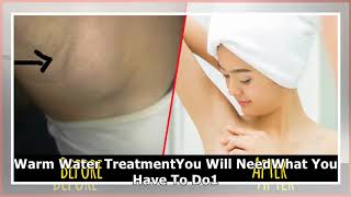 How To Get Rid Of Painful Lumps In The Armpit [upl. by Alleuqram]