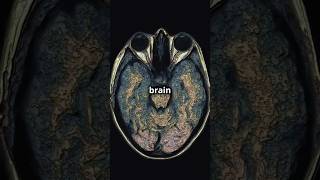 MetachromaticLeukodystrophy step2 medicalstudent genetics usmle DiagnosticLens [upl. by Eeresid]