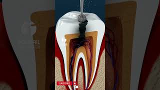 Root Canal Treatment [upl. by Aramot717]