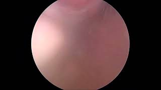 Bilateral endometrioma infertility [upl. by Clift769]