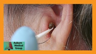 Chunky Earwax Removal  Auburn Medical Group [upl. by Anaert]