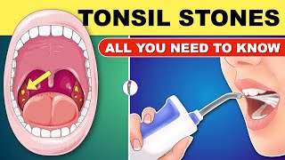 Tonsil Stones  Tonsil Stones Treatment  Tonsil Stone Removal  All You Need to Know [upl. by Guise]