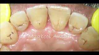 Scaling and Root Planing  Before and After Treatment [upl. by Lesirg]