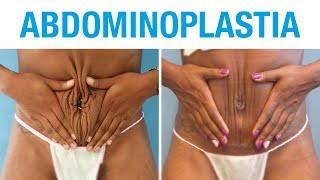 Abdominoplastia Opiniones  Clínicas Diego de León [upl. by Wobniar]