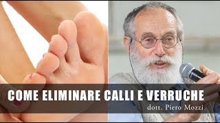 Come eliminare calli e verruche  Dr Mozzi [upl. by Thanasi827]