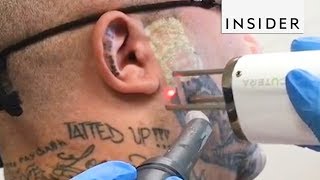 Eliminación de Tatuajes  Insider Español [upl. by Nnyl116]