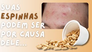 Uma toxina presente no amendoim pode estar causando sua Acne Disbiose e Síndrome Fúngica [upl. by Iruahs]