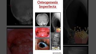 Osteogenesis imperfecta viralvideo shorts [upl. by Eglanteen]