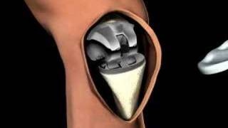 3D Medical Animation of a Knee Replacement [upl. by Vogele235]