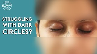 Laser treatment for dark circles under eyes [upl. by Githens]