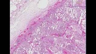 Histopathology Lung Lobar pneumonia [upl. by Nrubua507]