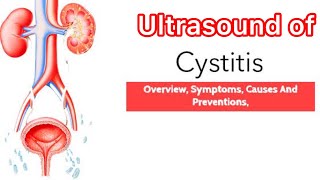 Treatment of Cystitis  Ultrasound of bladder cystitis  Medicine information  Medical knowledge [upl. by Utham]