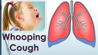 How do you Get Whooping Cough What is the cause of Whooping Cough [upl. by Ailyn822]