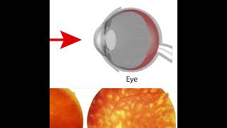 Birdshot Chorioretinopathy Symptoms and Causes  Diagnosis  Treatment  Prevention health [upl. by Ulani]