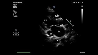 Dilated coronary sinus due to significant pulmonary hypertension [upl. by Lladnar461]