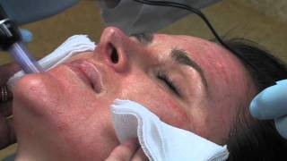 Dr Mark B Taylor Review of Dermapen Micro Needling  Gateway Aesthetics [upl. by Hamo]