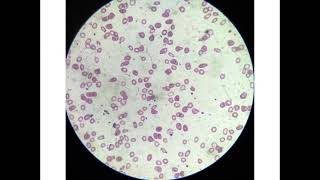 microcytic hypochromic anaemia [upl. by Petrine]