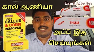 ஒரே மாதத்தில் கால் ஆணி சரியாக I Corn and callus Treatment in Tamil [upl. by Corinna980]