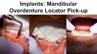 2 Implants Mandibular Overdenture Locator Pickup [upl. by Ciredec]