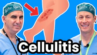 Cellulitis Explained By Infectious Disease Doc Red Sore And Swollen [upl. by Emmye650]