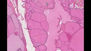 Histopathology ThyroidColloid goiter [upl. by Eelynnhoj]