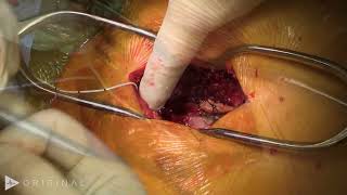 T3 Thoracic Laminectomy for Removal of an Intramedullary Spinal Cord Tumor Ependymoma [upl. by Gaye]