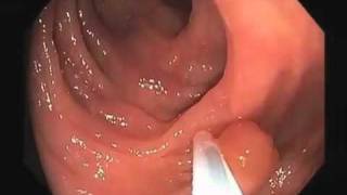 Colonoscopy Video Tour Removal of a Colon Polyp Polypectomy [upl. by Topper]