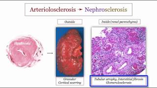 12DaysinMarch Blood Pressure IV Hypertensive Nephrosclerosis for the USMLE Step One Exam [upl. by Kernan145]