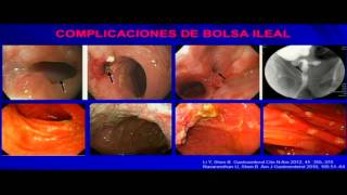 Pouchitis DiagnoÌstico y Tratamiento [upl. by Janith]