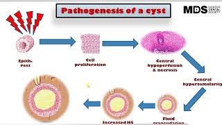 3 Pathogenesis of a cyst [upl. by Yknip]