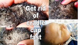 Cradle cap treatment  Cradle cap in babies [upl. by Asiluj802]