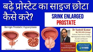 प्रोस्टेट को कैसे कम करें Prostate size Reduction How  ProfSantosh Kumar PGI [upl. by Colb685]