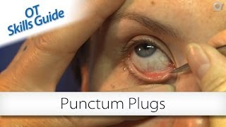 OT skills guide punctum plugs [upl. by Pasquale]