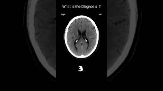 Lateral ventricles  CT brain CT Brain Anatomy CSF spaces Quiz 17radiologychannel007 [upl. by Ellocin]